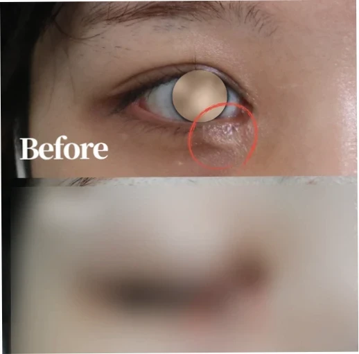 눈을 크게 확대한 모습으로, 수술 전 쌍꺼풀수술흉터 부위가 붉은 원으로 표시되어 두껍고 울퉁불퉁한 절개 라인으로 남아있는 모습을 보여줍니다.