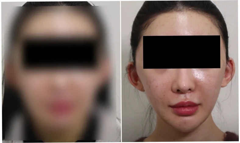 안면윤곽 수술 전후를 비교하는 듯한 여성의 얼굴. 왼쪽은 흐릿한 상태, 오른쪽은 눈을 가린 채 안면윤곽 흉살 등 피부 변화를 확대한 모습.
