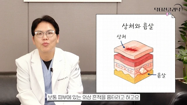 의사가 피부 상처와 흉살 깊이 다이어그램을 보며 비절개흉살치료레이저에 대해 설명하는 모습.